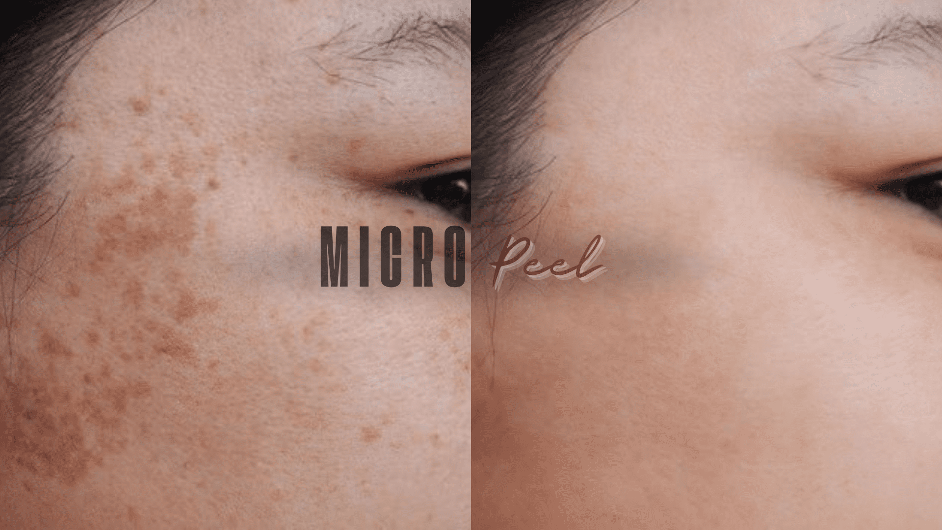 Micropeel